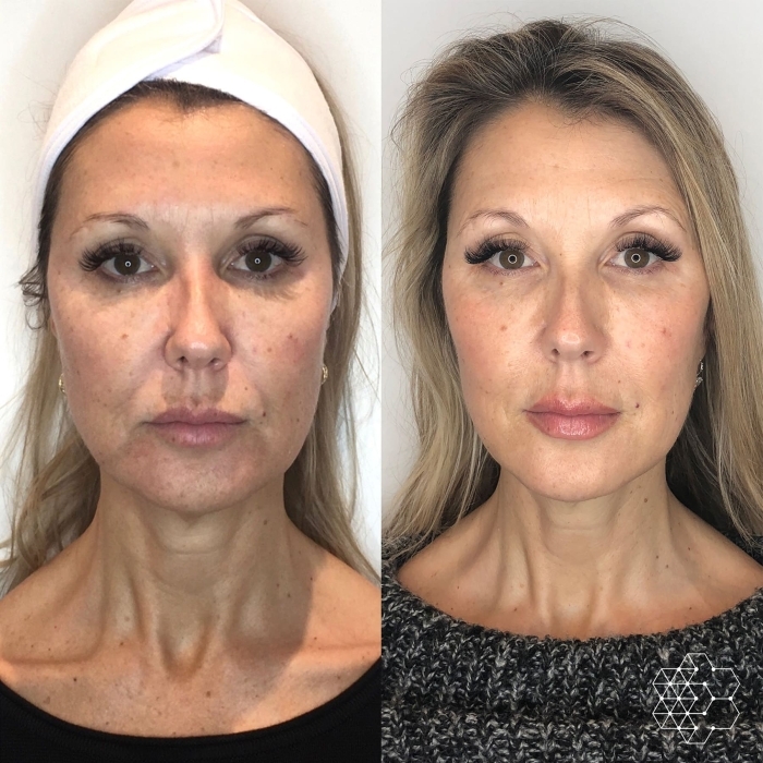 HALO™ Fractional Resurfacing