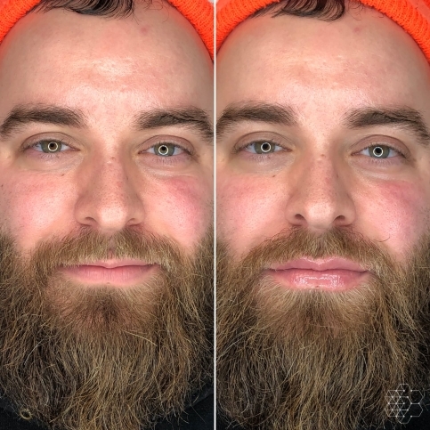 Male Lip Enhancement