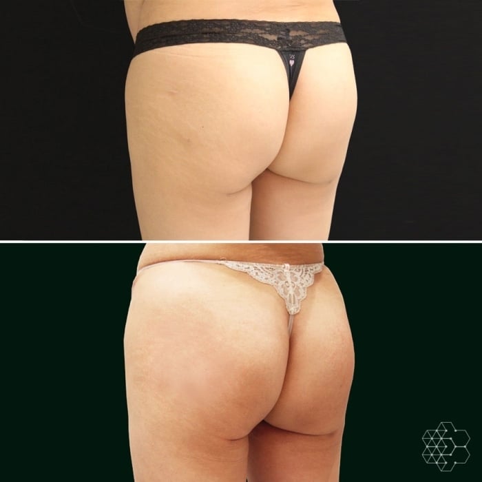 Buttocks Enhancement