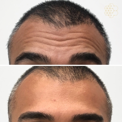 Forehead Lines Correction