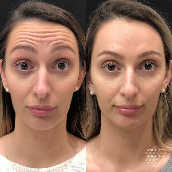 Forehead Lines Correction
