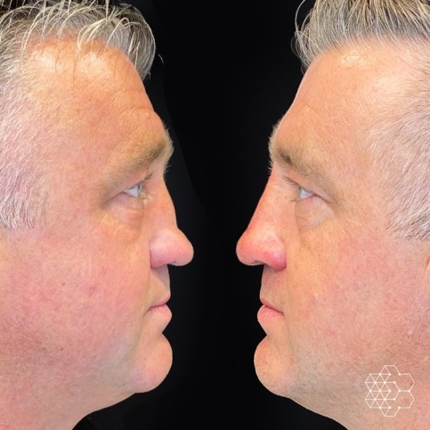 Non Surgical Nose Job