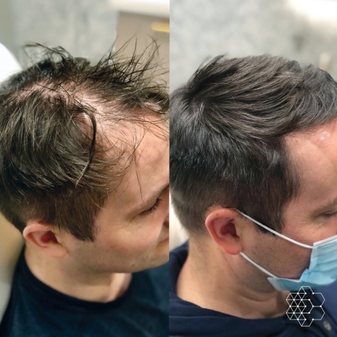 PRP Hair Restoration