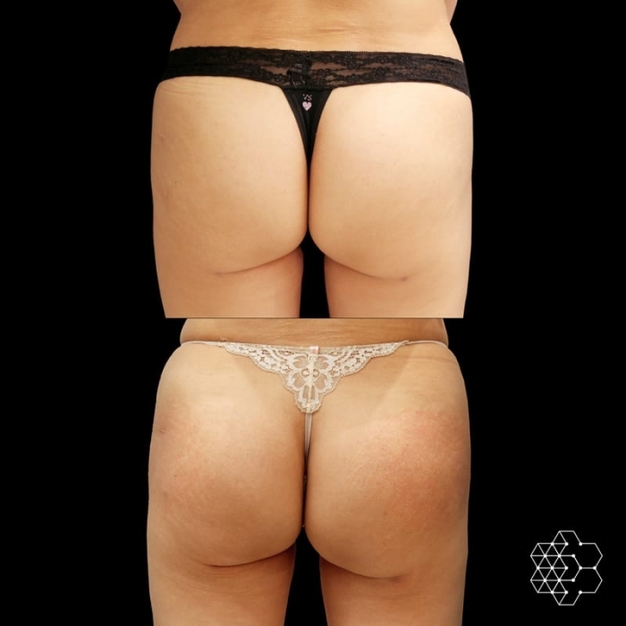 Buttocks Enhancement