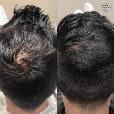 PRP Hair Restoration