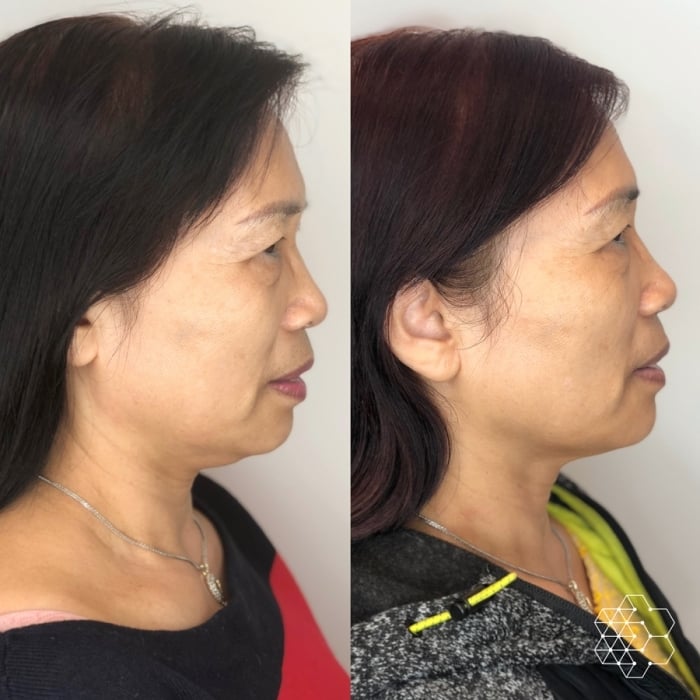 Double Chin Treatment