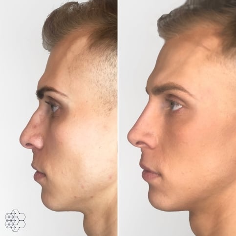 Non Surgical Nose Job