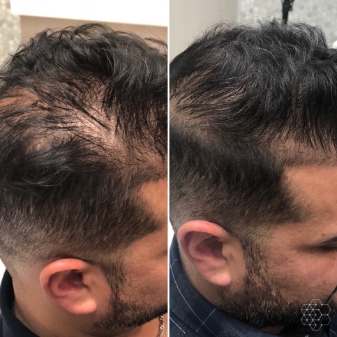 PRP Hair Restoration