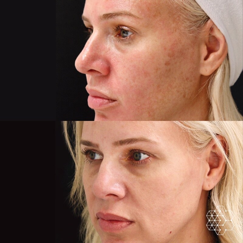 Microneedling