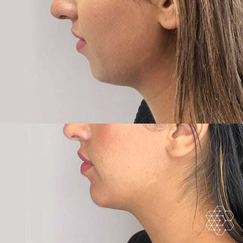 Chin Filler
