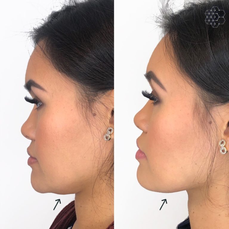 Double Chin Correction