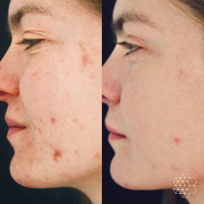 Chemical Peel combined with the Complexion Clearing Program by ZO