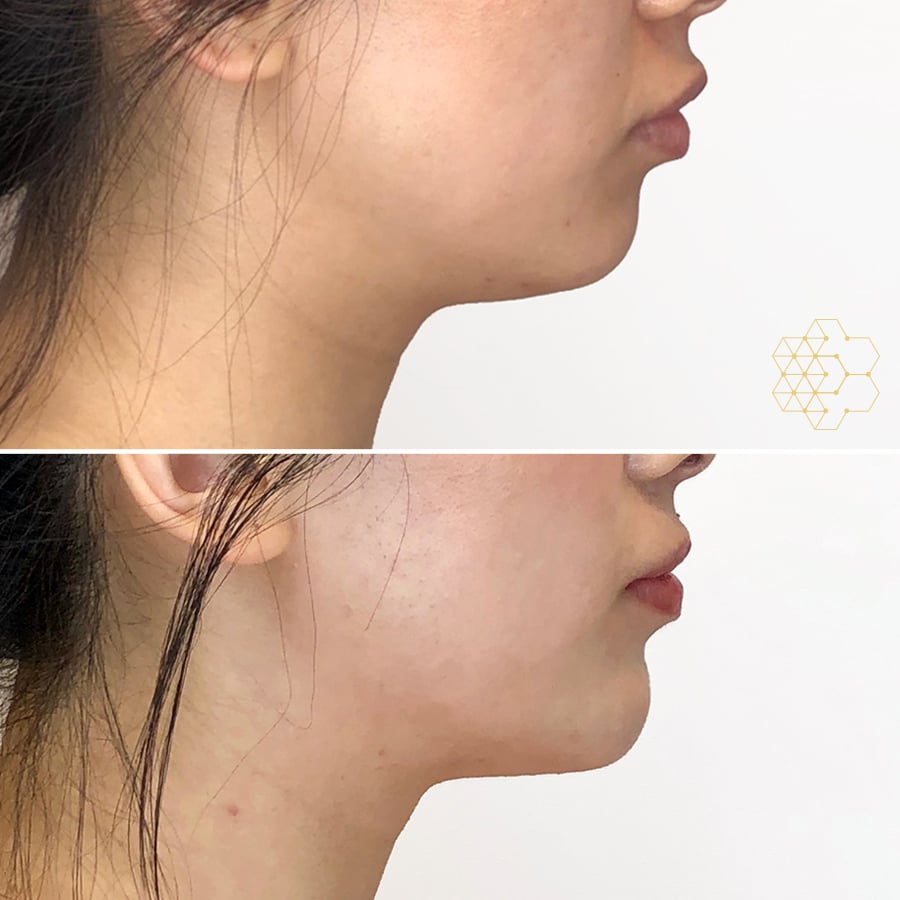 Chin Enhancement