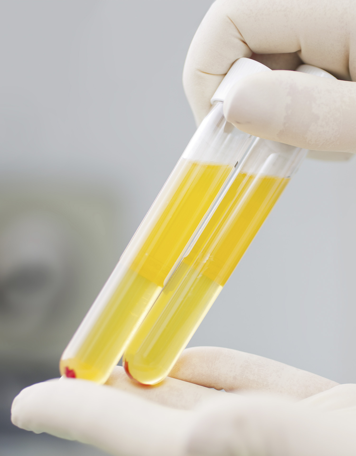 Platelet Rich Plasma Therapy (PRP)