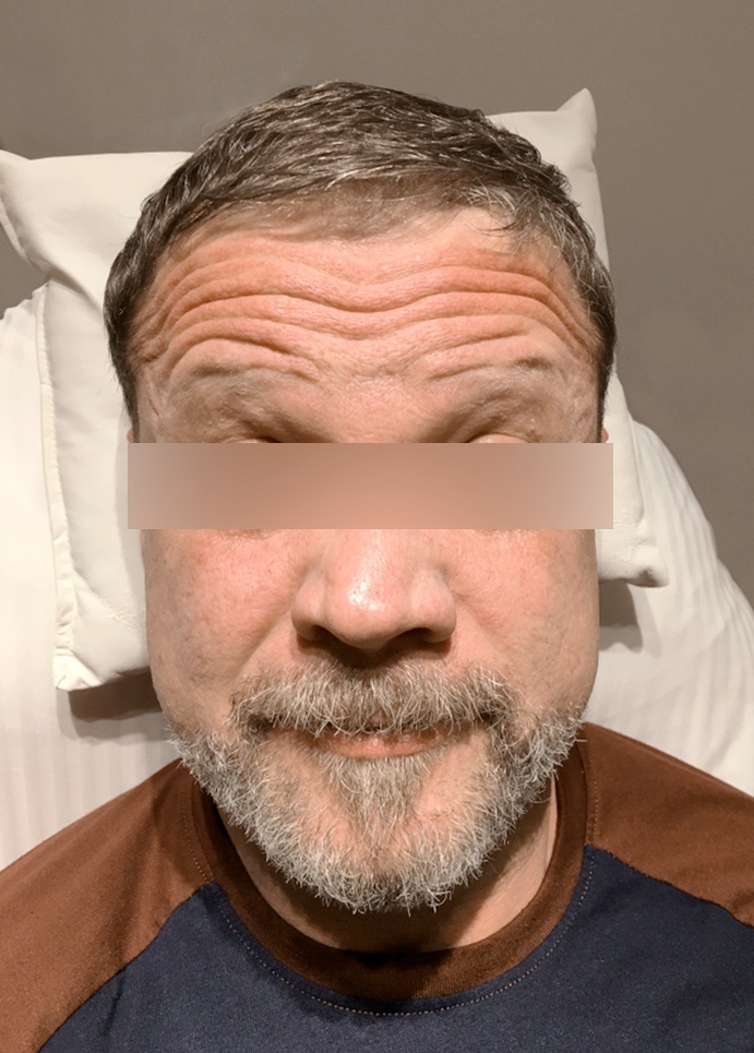 Forehead Lines Correction