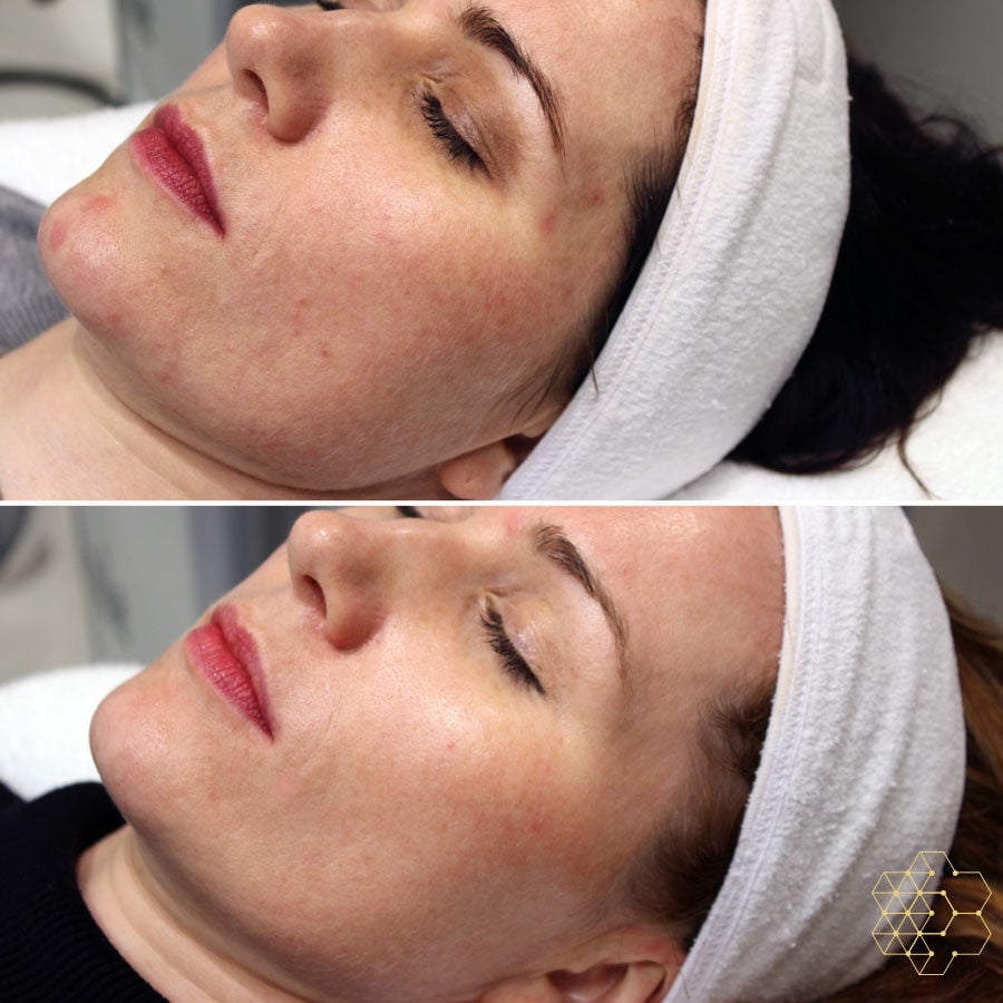 Forever Bare BBL™ (Laser Hair Removal)