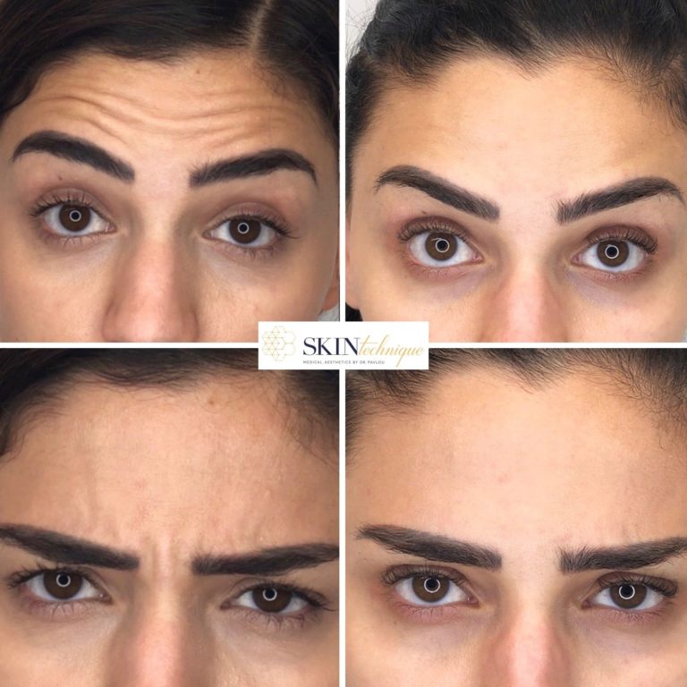 Forehead Lines Correction