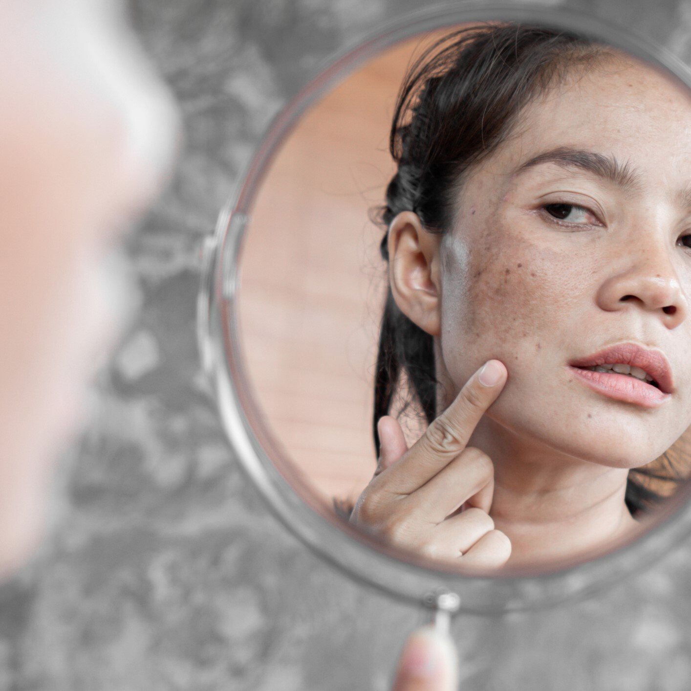 Freckle & Brown Spot Treatment in Vancouver