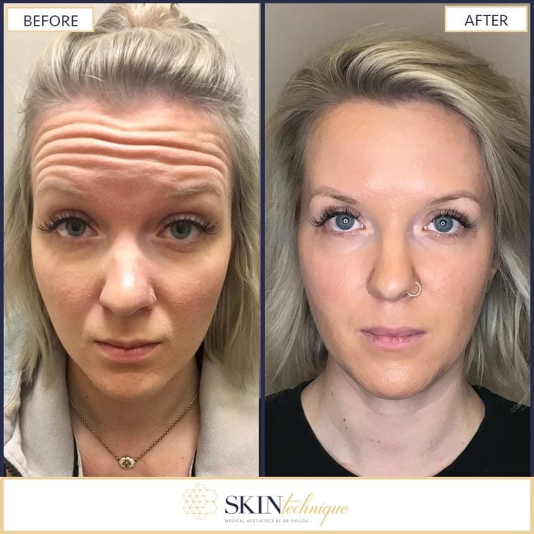 Forehead Lines Correction