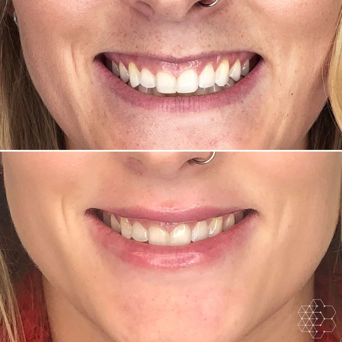 Gummy Smile Correction