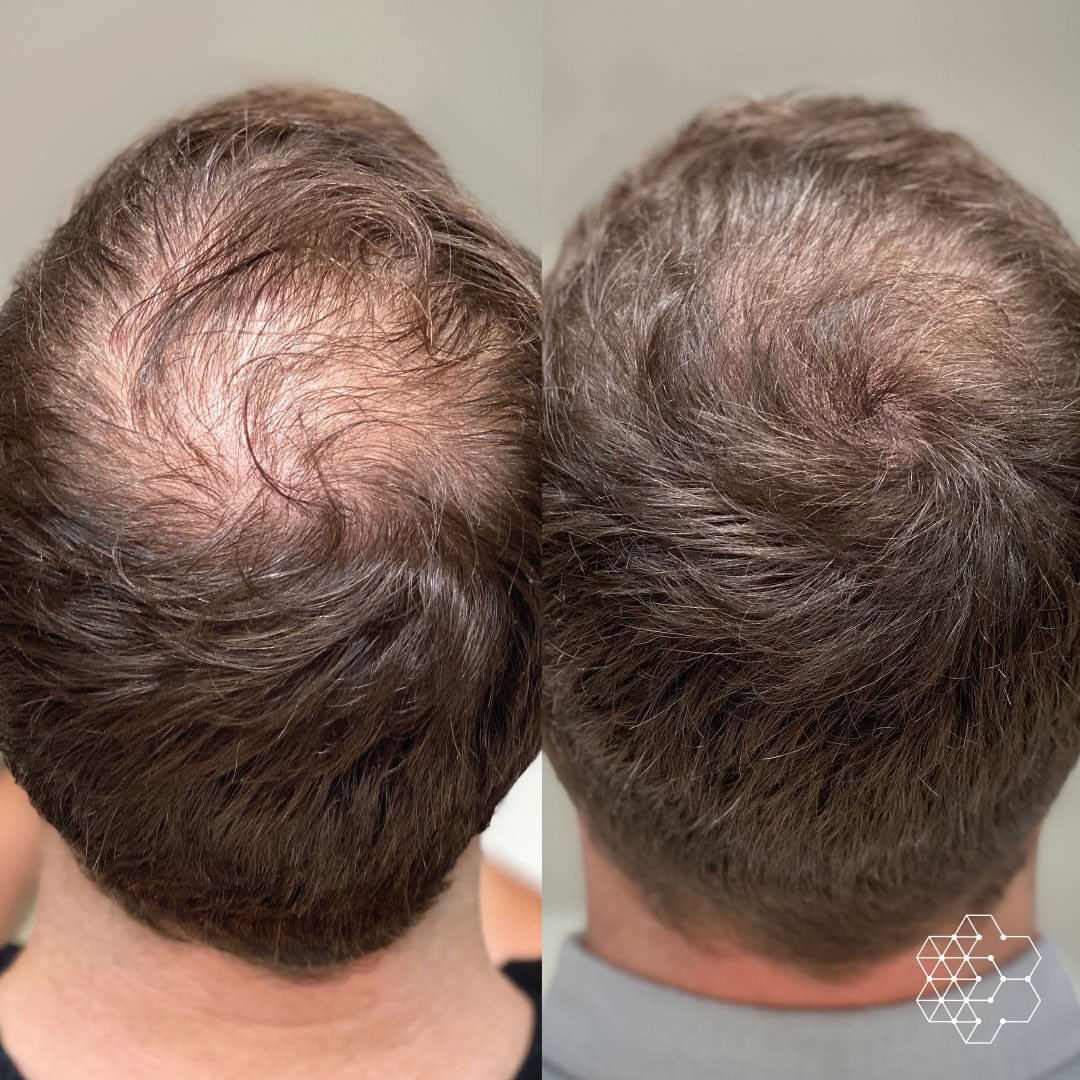 Why Is PRP Hair Therapy More Effective than Others?