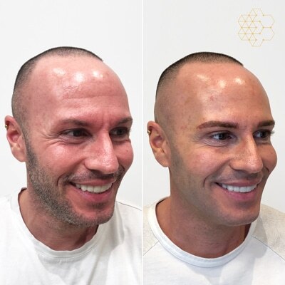 HALO™ Fractional Resurfacing