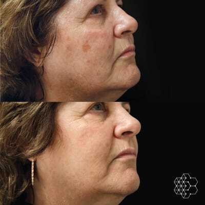 HALO™ Fractional Resurfacing