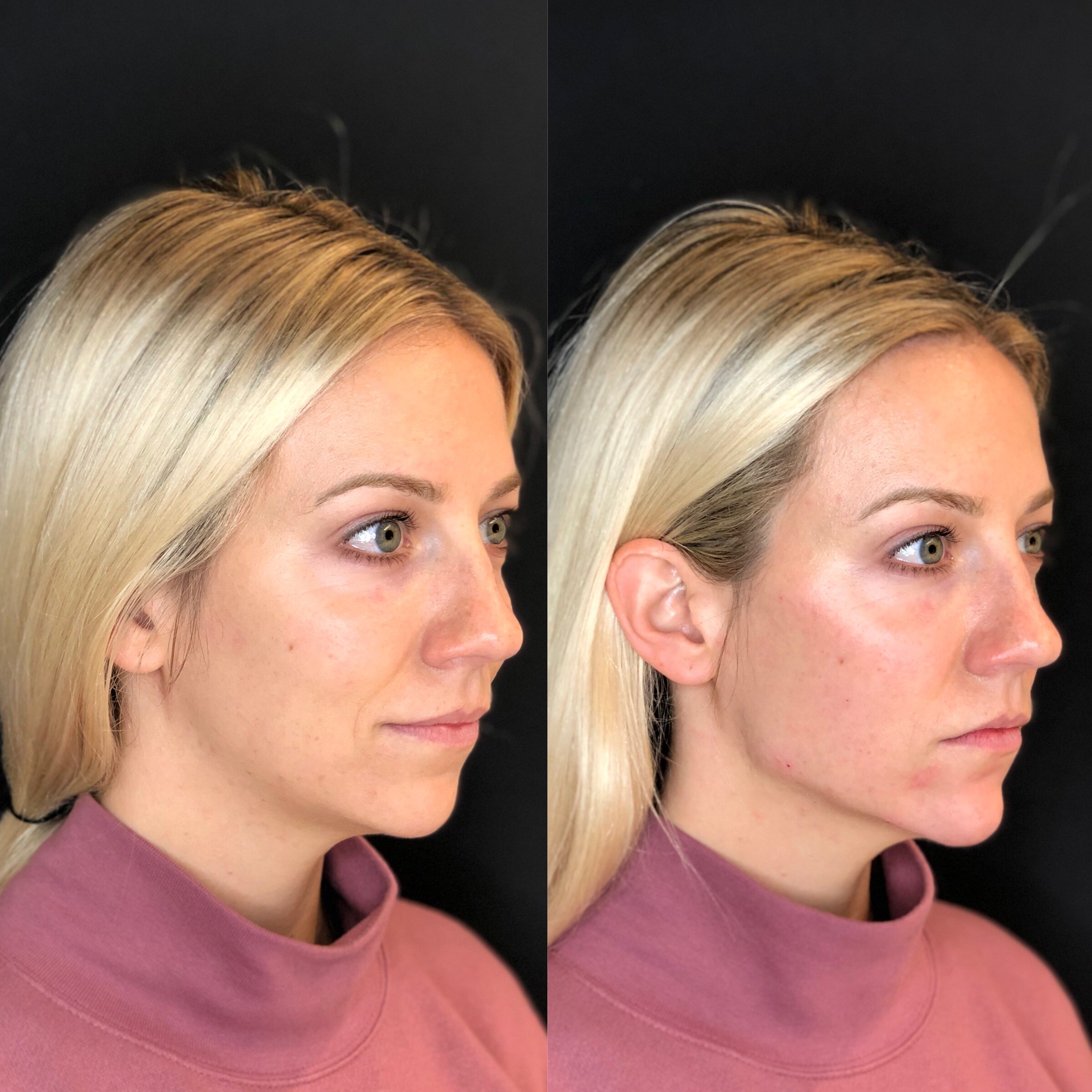 Get A Chiseled Jawline Without Surgery