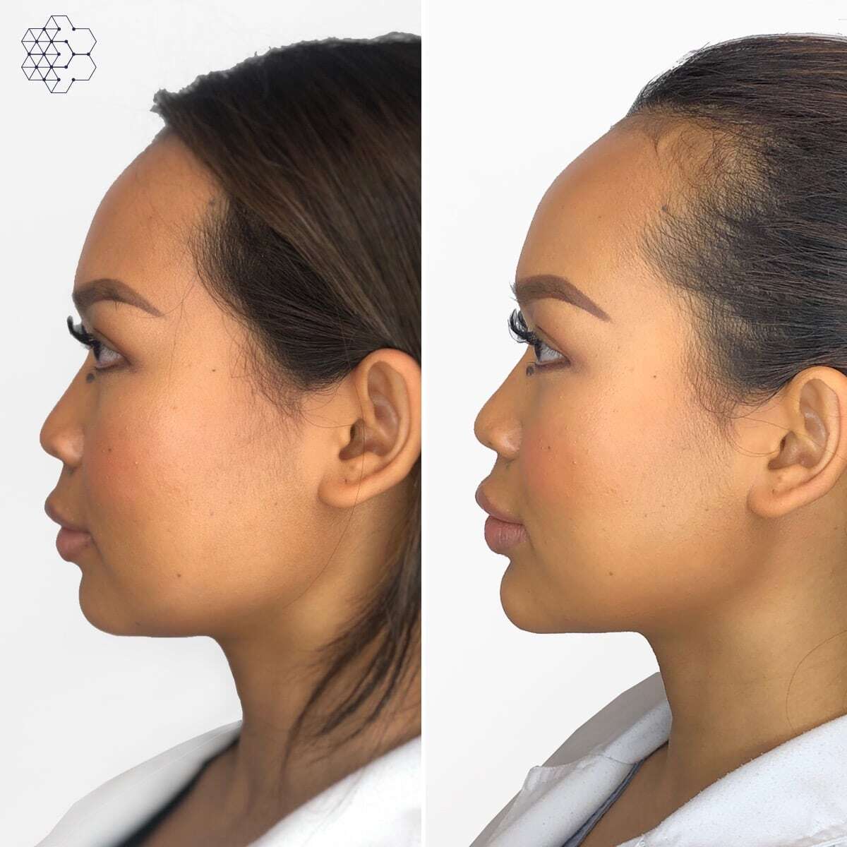 Jawline Contouring