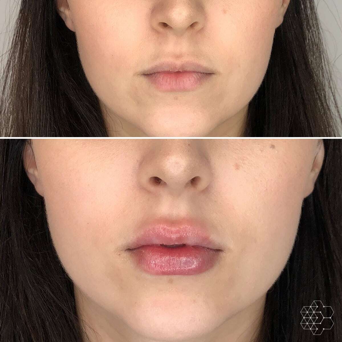 Lip Enhancement