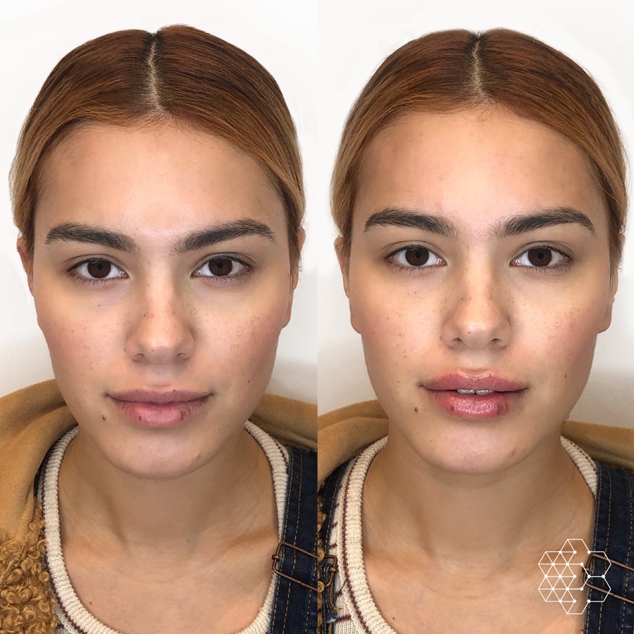 Lip Enhancement