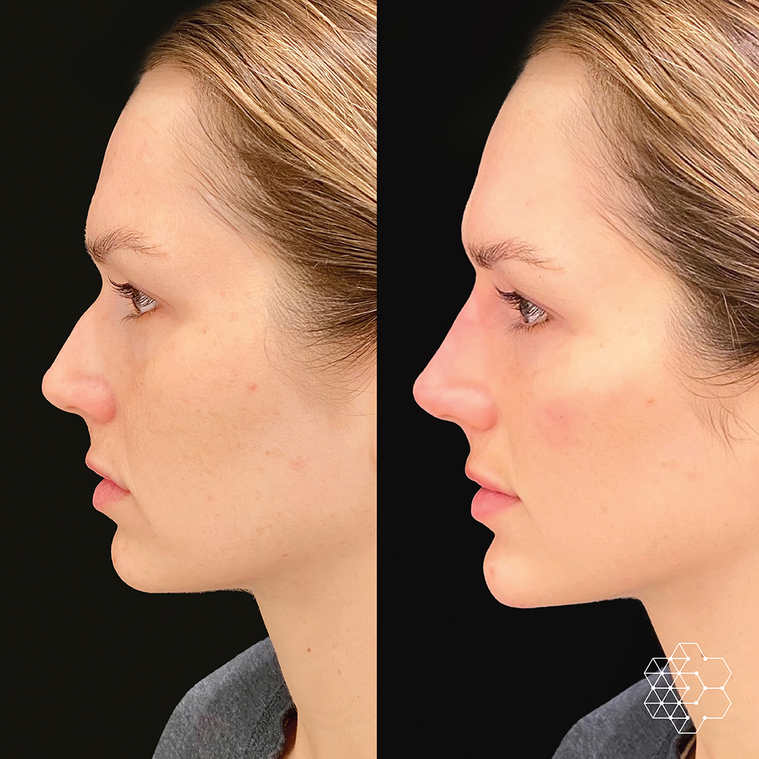 MystLift™ Beautification