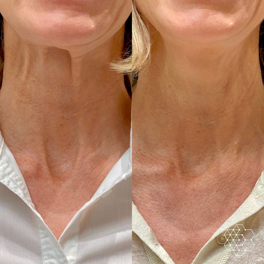 Neck Lines and Laxity Treatments in Vancouver