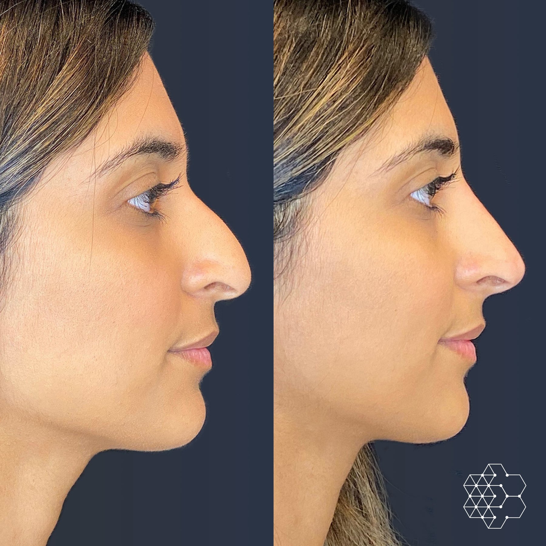 Non-Surgical Nose Job