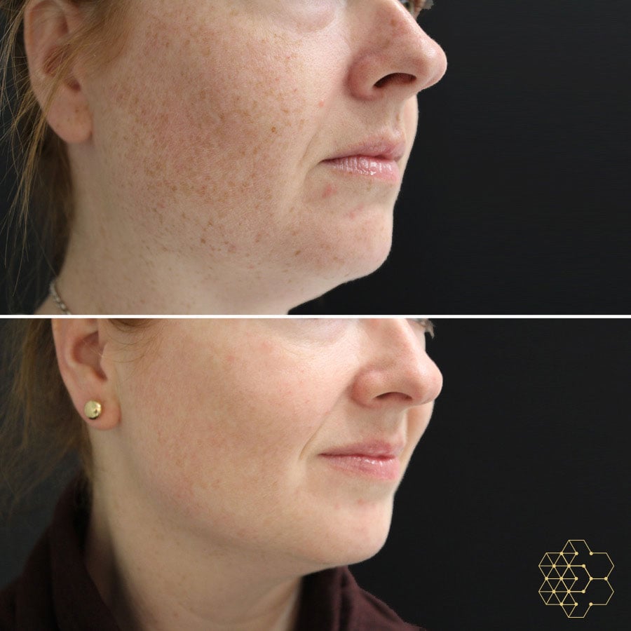 Pigmentation Treatment in Vancouver