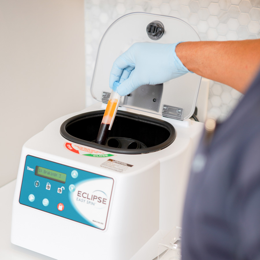 Microneedling with Radio Frequency Skin Tightening and/or PRP (Platelet Rich Plasma)