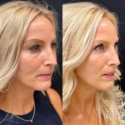 Liquid Face Lift
