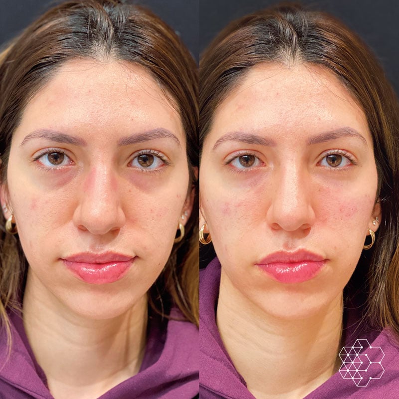 TiredEye™ Treatment