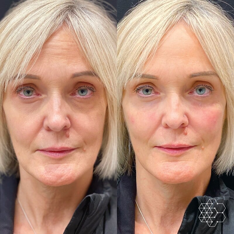 TiredEye™ Treatment