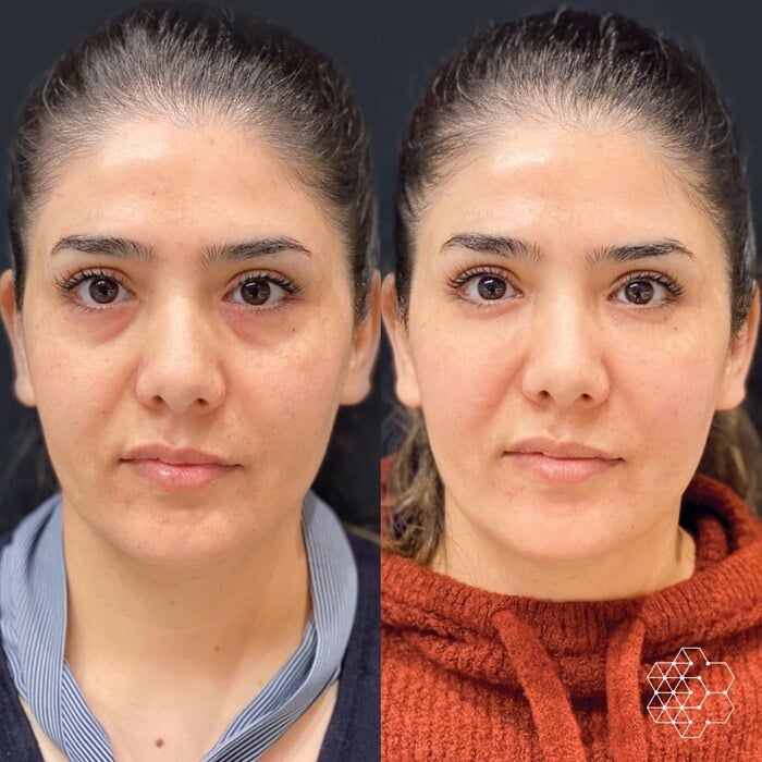 TiredEye™ Treatment