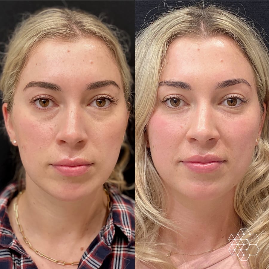 TiredEye™ Treatment