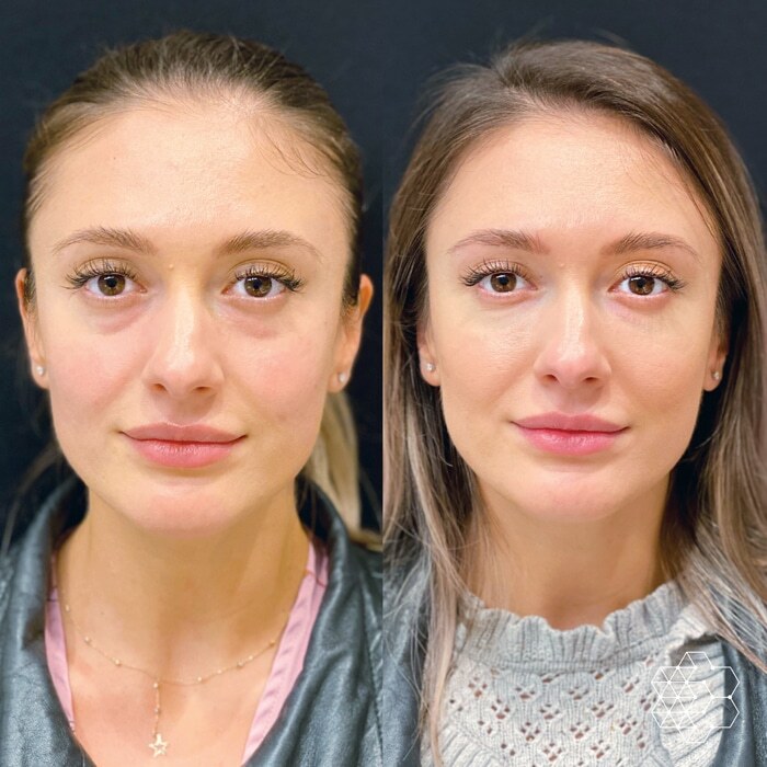 TiredEye™ Treatment