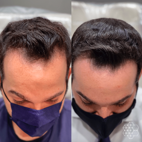 PRP Hair Restoration