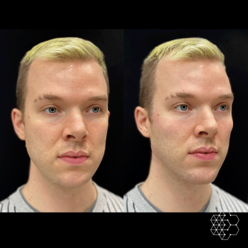 Jawline Masculinization