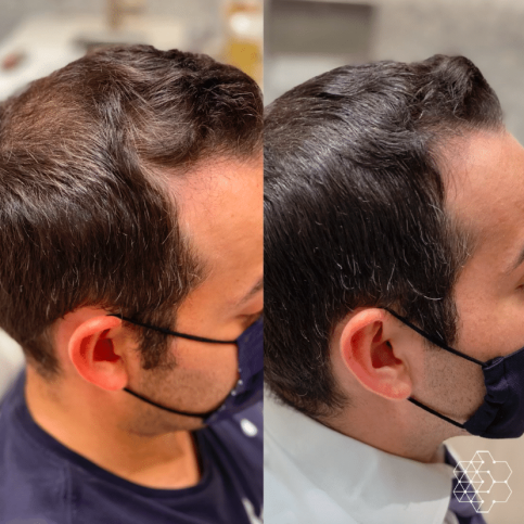 PRP Hair Restoration