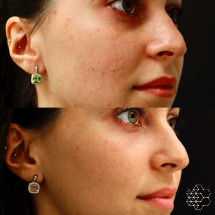 HALO™ Fractional Resurfacing + Forever Young BBL Combo