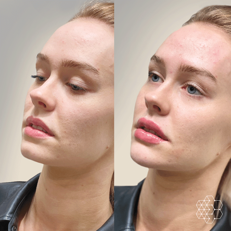 Beautification Procedure