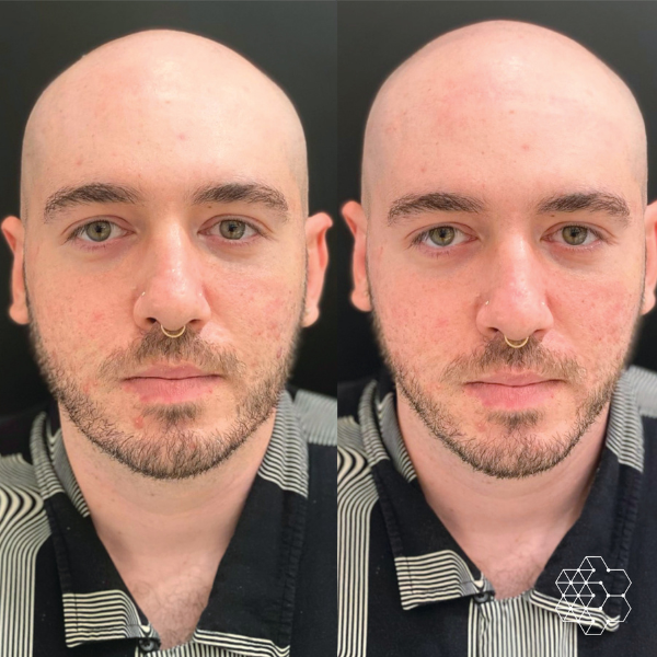 Jawline Masculinization