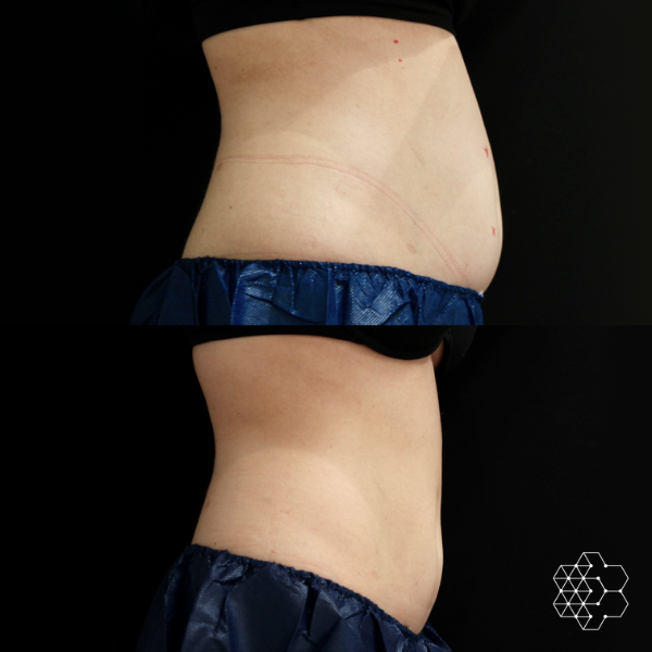 CoolSculpting