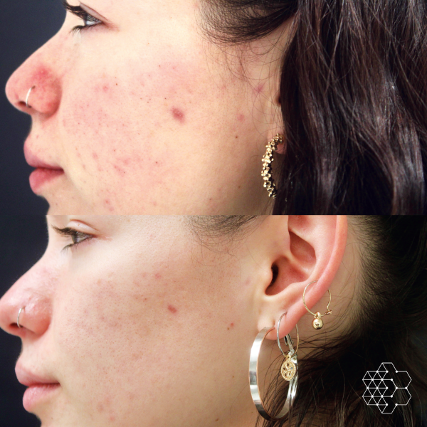 Before and after image of Forever Young BBL treatment showing improved complexion